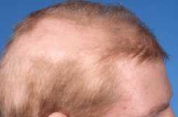 Pletskaldethed [Alopecia areata]