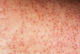 Sandpapirshud. Keratosis pilaris