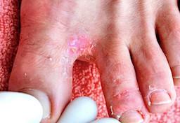 Svampeinfektion. Fodsvamp (tinea pedis)
