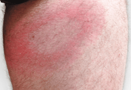 Ringformet udslæt på kroppen -smittet med borrelia-bakterien