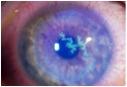 herpes simplex keratitis.jpg