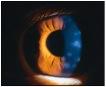 Herpes Zoster, nummulat keratitis.jpg