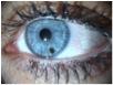 benign iris pigmentering.jpg