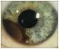 iris melanoma.jpg
