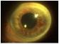 iris rubeosis.jpg