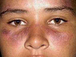 Rød lupus, almen sygdom (lupus erythematosus, LE)