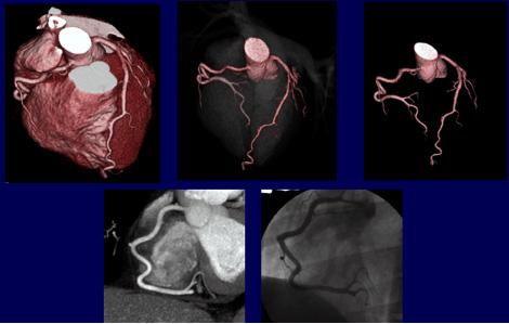 Hjerte-CT af kranspulsåre