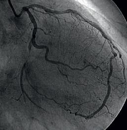 koronararteriografi af venstre kranspulsåre